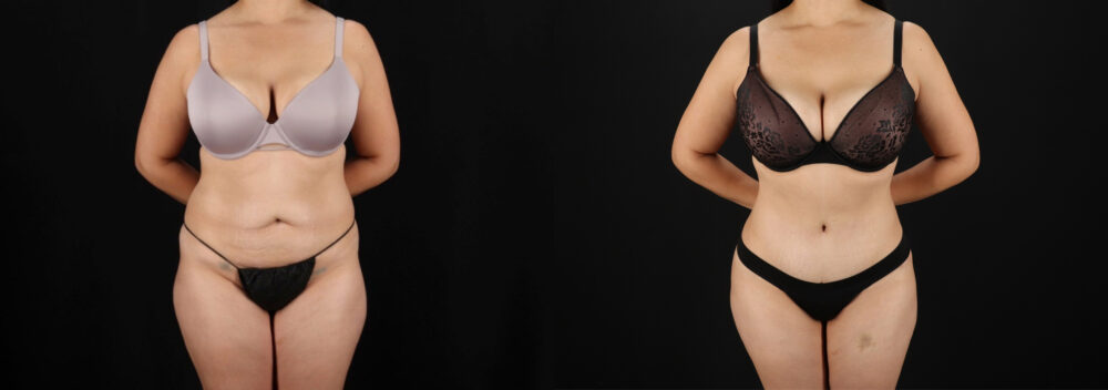 Tummy Tuck case #7462