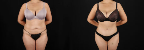 Tummy Tuck case #7462