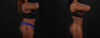 Brazilian Butt Lift case #5265 slider thumbnail