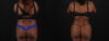 Brazilian Butt Lift case #5265 slider thumbnail