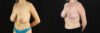 Breast Reduction case #7982 slider thumbnail