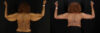 Arm Lift case #6780 slider thumbnail
