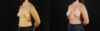 Breast Augmentation case #6364 slider thumbnail