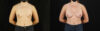 Breast Augmentation case #6364 slider thumbnail