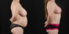 Mommy Makeover case #6522 slider thumbnail