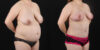 Mommy Makeover case #6522 slider thumbnail