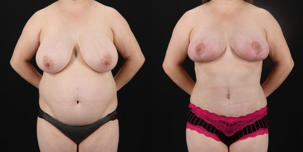 Mommy Makeover case #6522