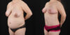 Mommy Makeover case #6522 slider thumbnail
