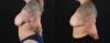 Mommy Makeover case #6523 slider thumbnail
