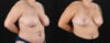 Mommy Makeover case #6523 slider thumbnail