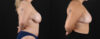 Mommy Makeover case #6523 slider thumbnail