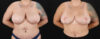 Mommy Makeover case #6523 slider thumbnail