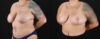 Mommy Makeover case #6523 slider thumbnail