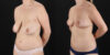 Breast Lift case #7768 slider thumbnail
