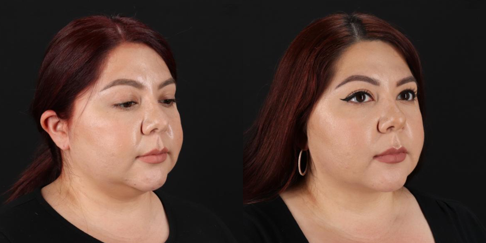 Submental Liposuction case #6952