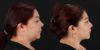 Submental Liposuction case #6952 slider thumbnail