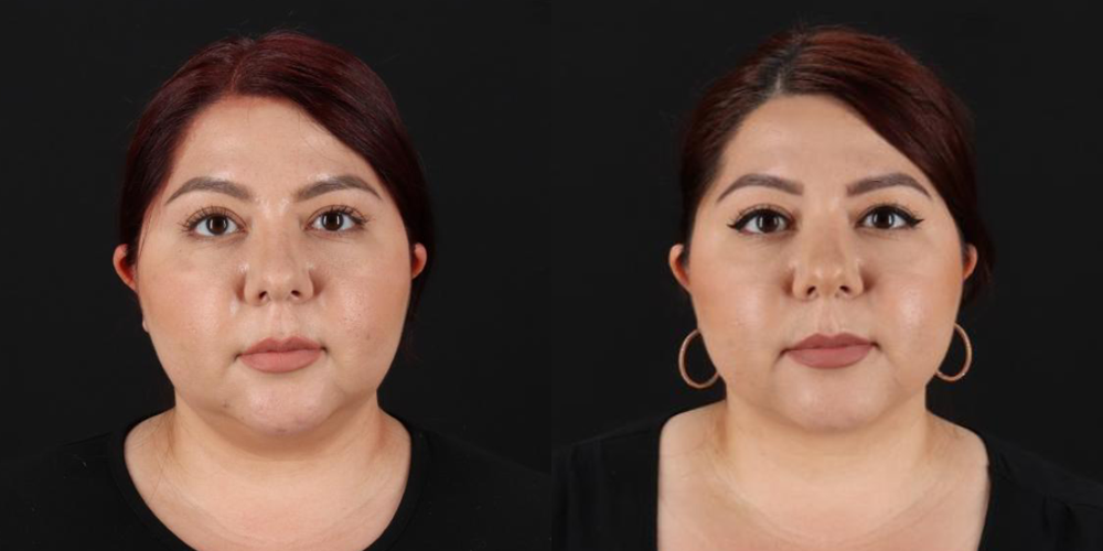 Submental Liposuction case #6952