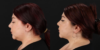 Submental Liposuction case #6952 slider thumbnail