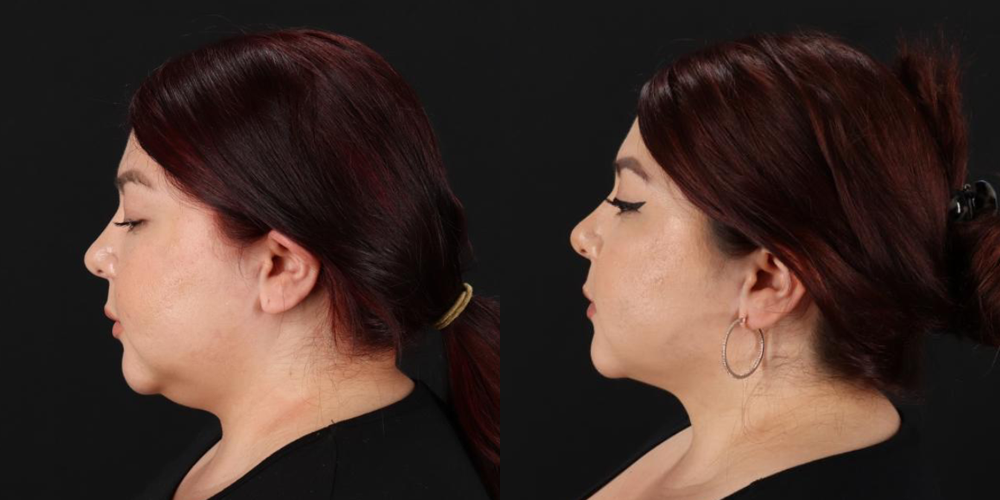Submental Liposuction case #6952