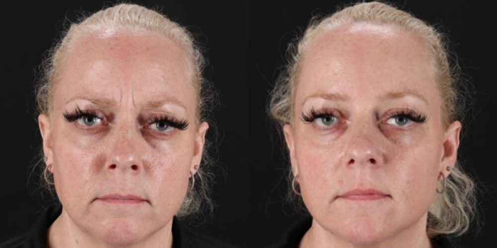 Botox® & Other Neuromodulators case #5030