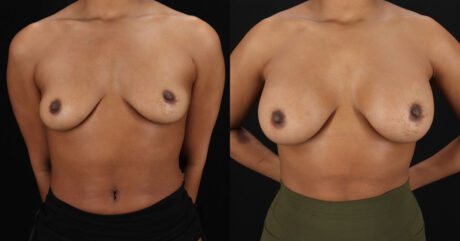 Breast Augmentation case #6390