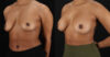 Breast Augmentation case #6390 slider thumbnail