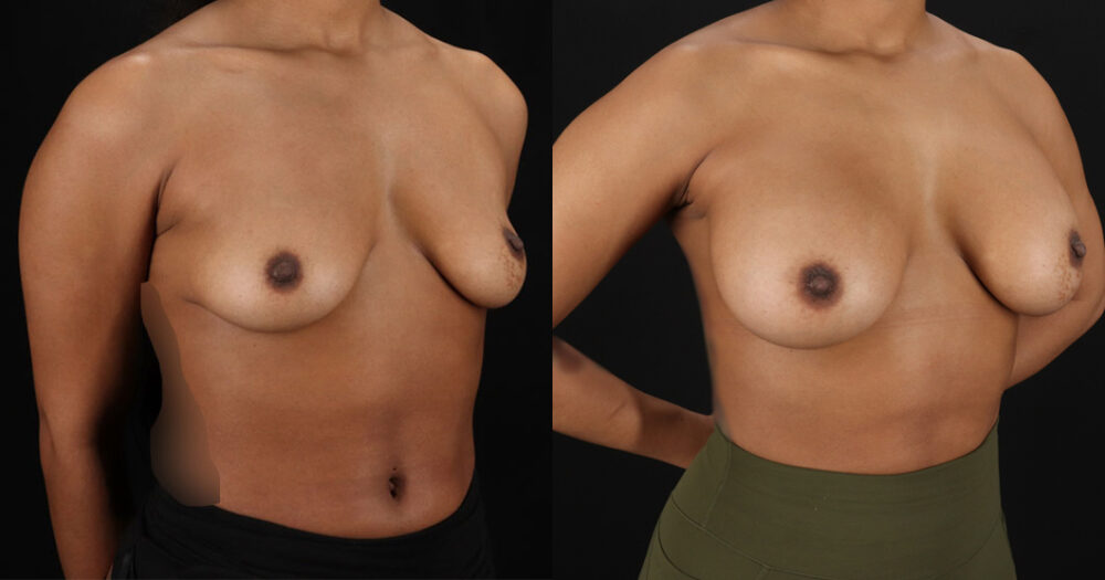 Breast Augmentation case #6390