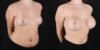 Breast Augmentation case #6396 slider thumbnail