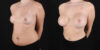 Breast Augmentation case #6396 slider thumbnail