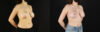 Breast Lift with Implants case #7884 slider thumbnail