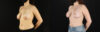 Breast Lift with Implants case #7884 slider thumbnail