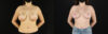 Breast Lift with Implants case #7884 slider thumbnail