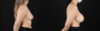Breast Augmentation case #6402 slider thumbnail
