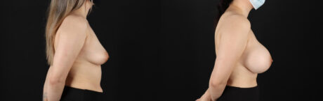 Breast Augmentation case #6402