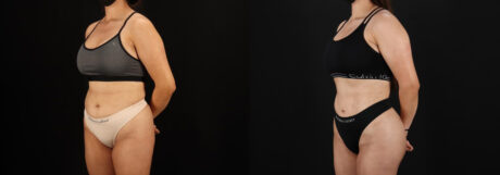 Brazilian Butt Lift case #5264