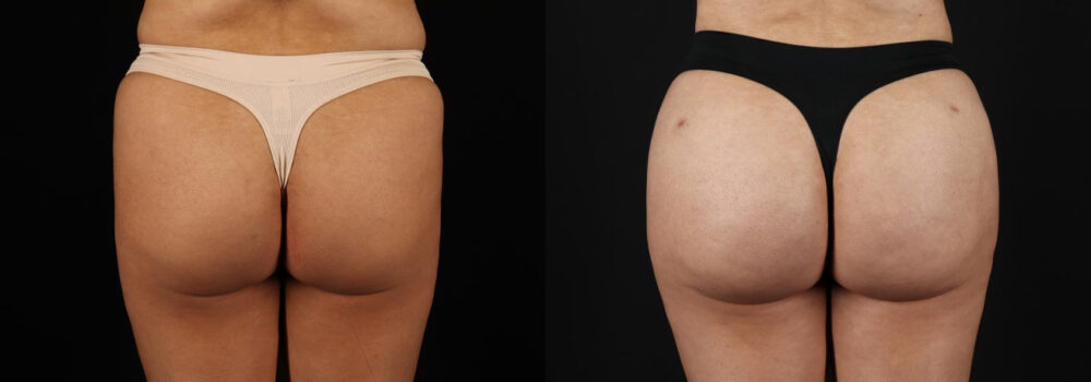Brazilian Butt Lift case #5264