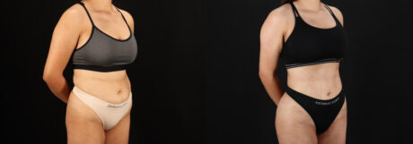Brazilian Butt Lift case #5264
