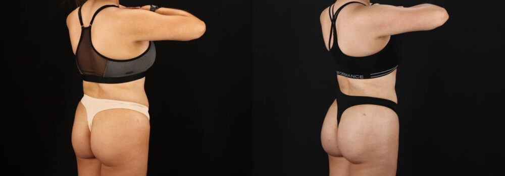 Brazilian Butt Lift case #5264