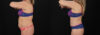 Tummy Tuck case #7775 slider thumbnail