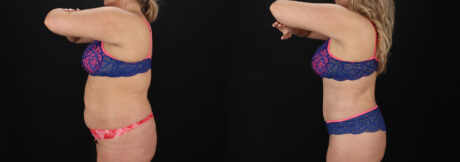 Tummy Tuck case #7775