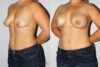 Breast Augmentation case #5607 slider thumbnail