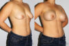 Breast Augmentation case #5607 slider thumbnail