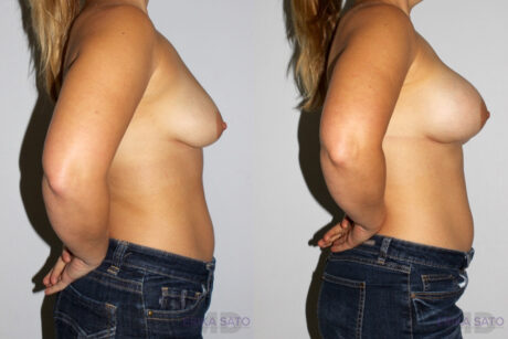 Breast Augmentation case #5607