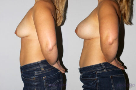 Breast Augmentation case #5607