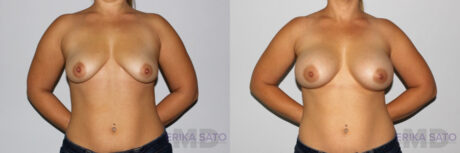 Breast Augmentation case #5607