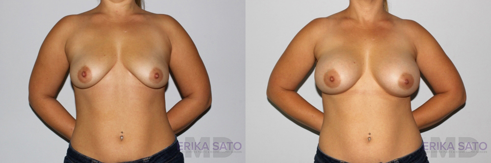 Breast Augmentation case #5607