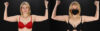 Liposuction case #6017 slider thumbnail