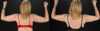 Liposuction case #6017 slider thumbnail