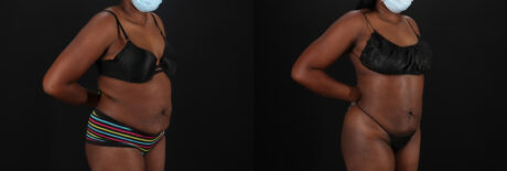 Liposuction case #6016