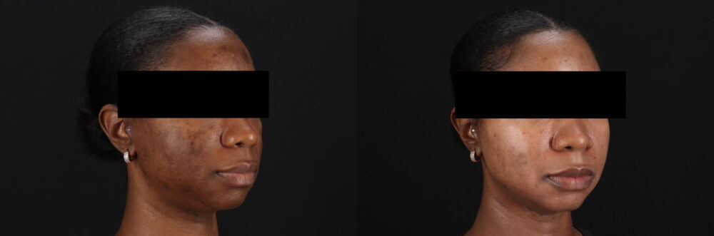 Cosmelan Chemical Peel case #5075